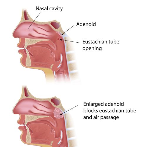 tonsils and adenoids surgery