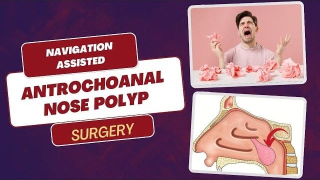 NosePolypsSurgery